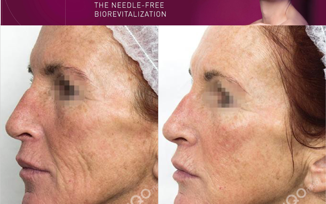 Everything you need to know about our fabulous PRX-T33 Therapy